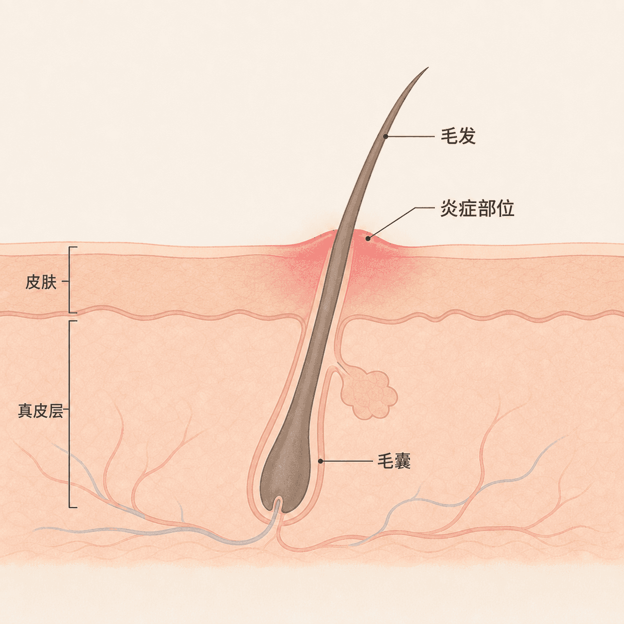 脱毛后为什么会产生毛囊炎?
