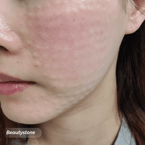 리쥬란 효과 적응증 피부 타입별 비교 홍대 뷰티스톤의원