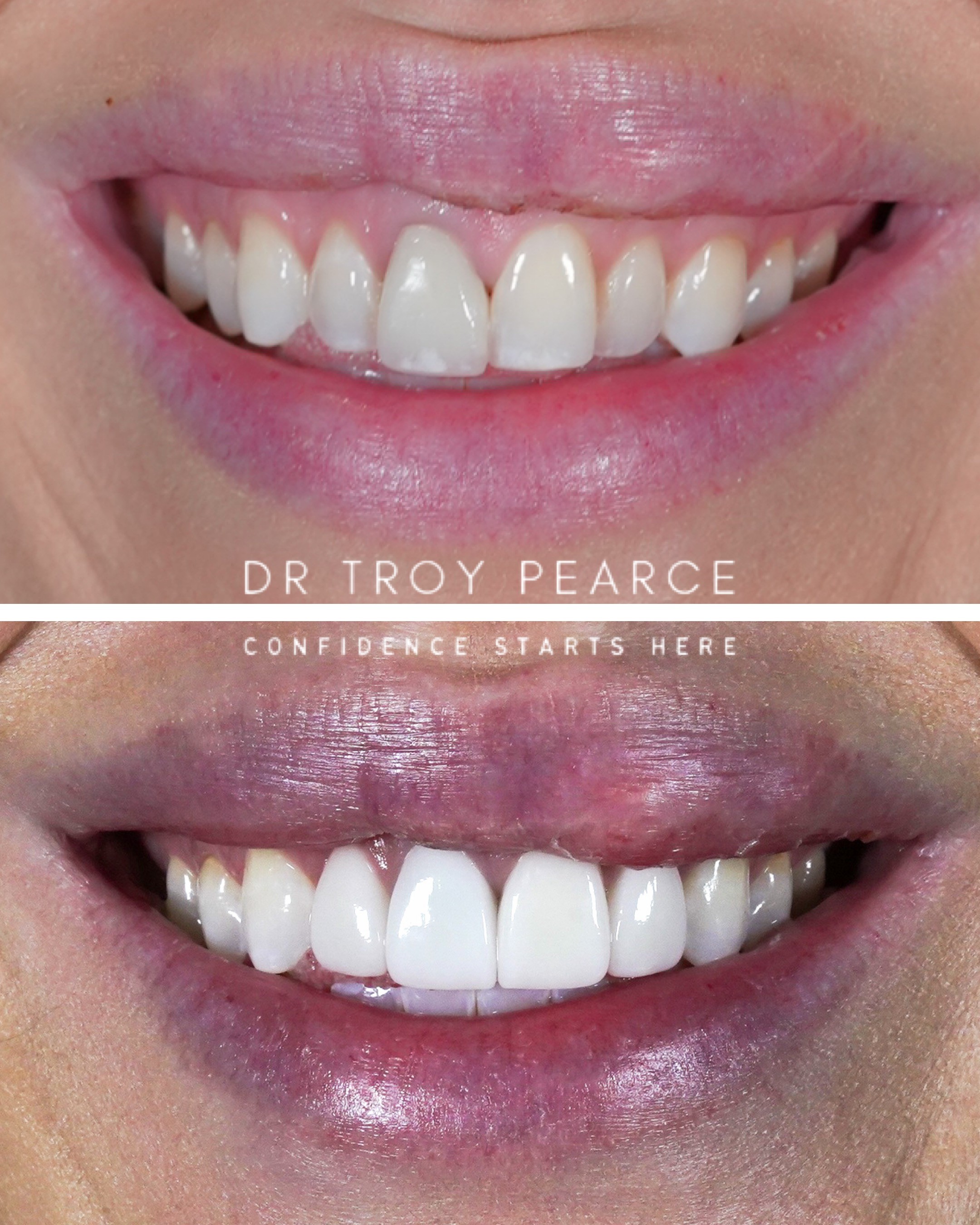 invisalign 