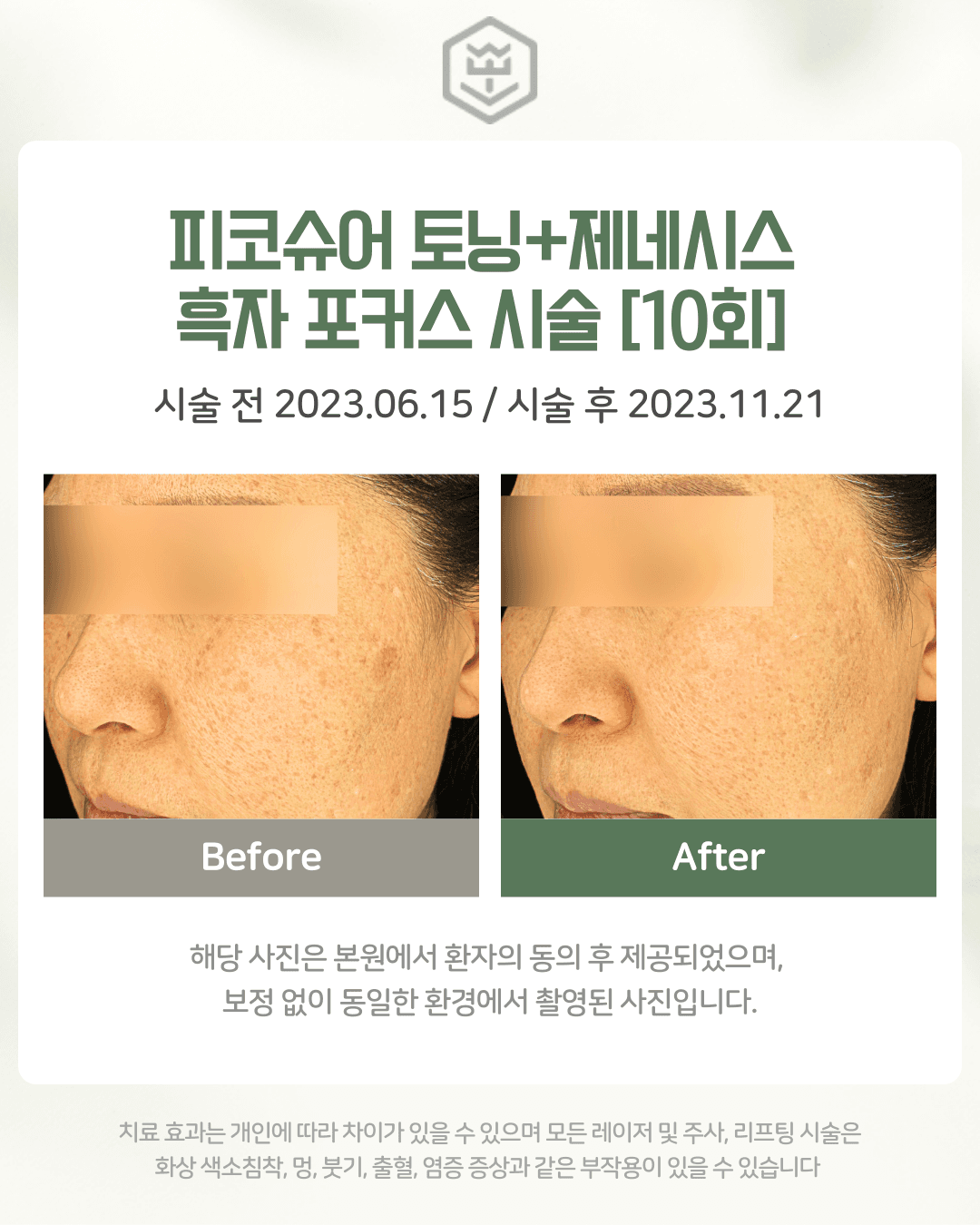 피코슈어+제네시스+흑자포커스 10회