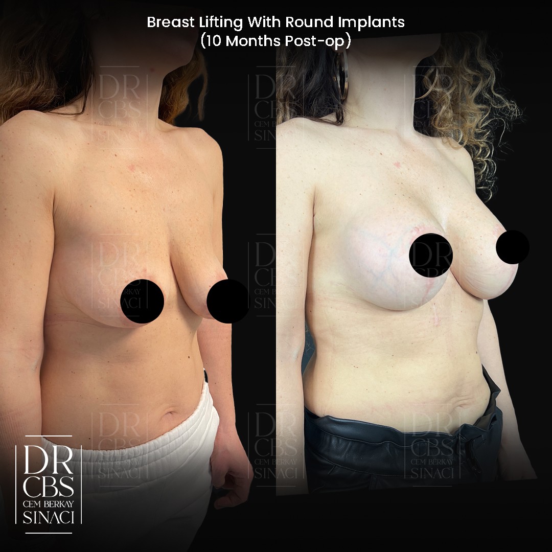 10 months before after breast lift with implant in Istanbul Turkey oblique view