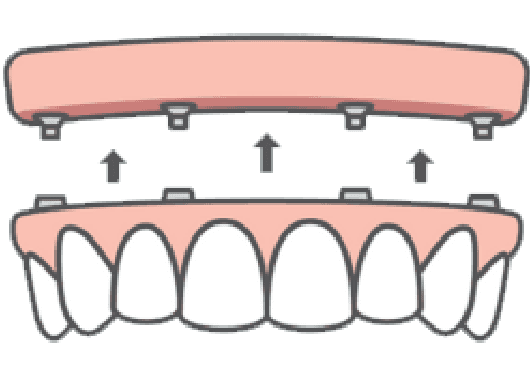 All-on-X full arch dental implants icon