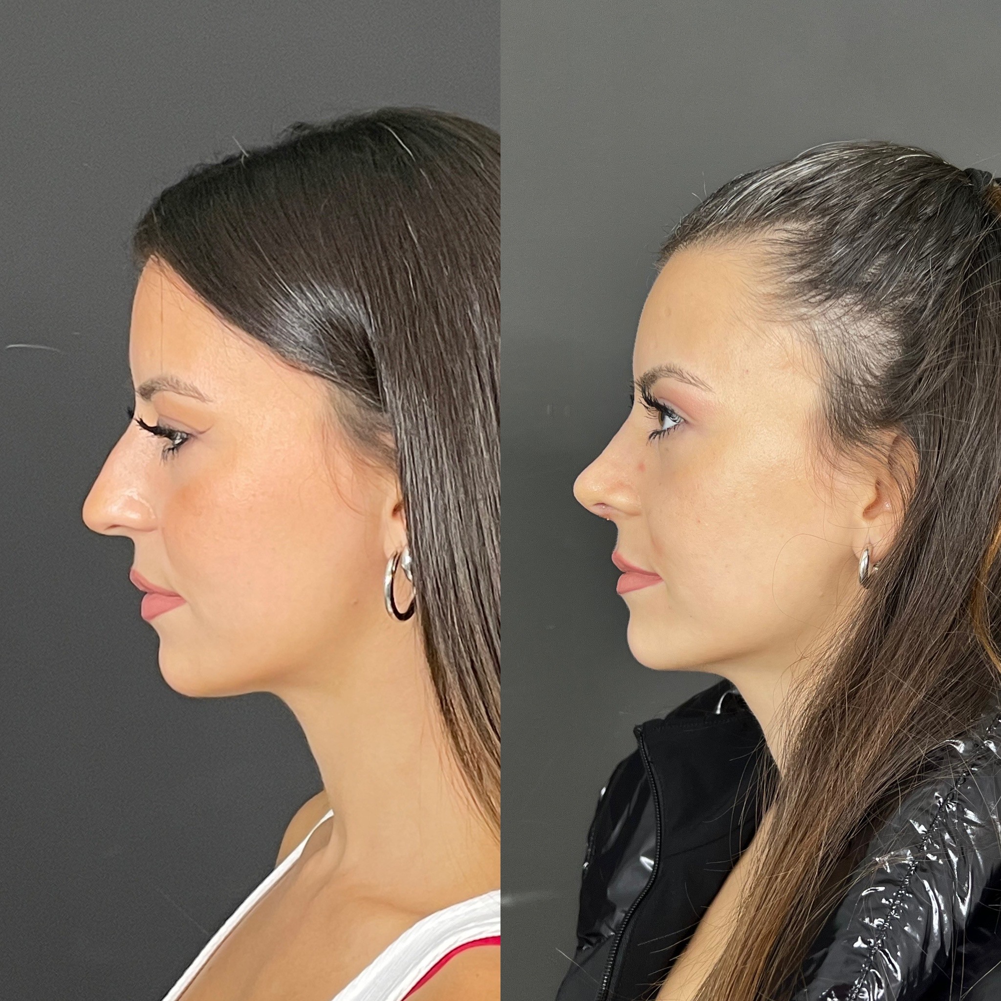 10 days rhinoplasty patient before after side view