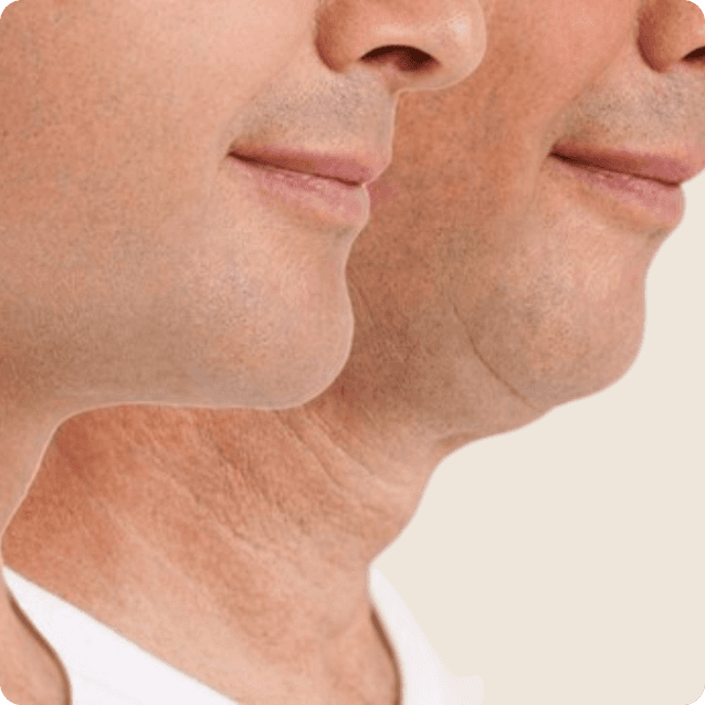 Close-up view of a man's chin area before undergoing mentoplasty, showcasing a weaker jawline or chin that he wishes to enhance. The man has a neutral expression, and the clinical setting features markings indicating areas of focus for the chin surgery aimed at improving facial balance and profile.