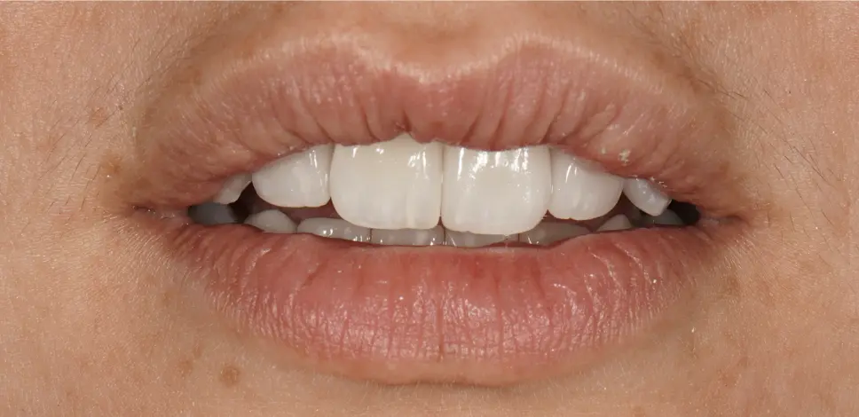 After prosthetic rehabilitation