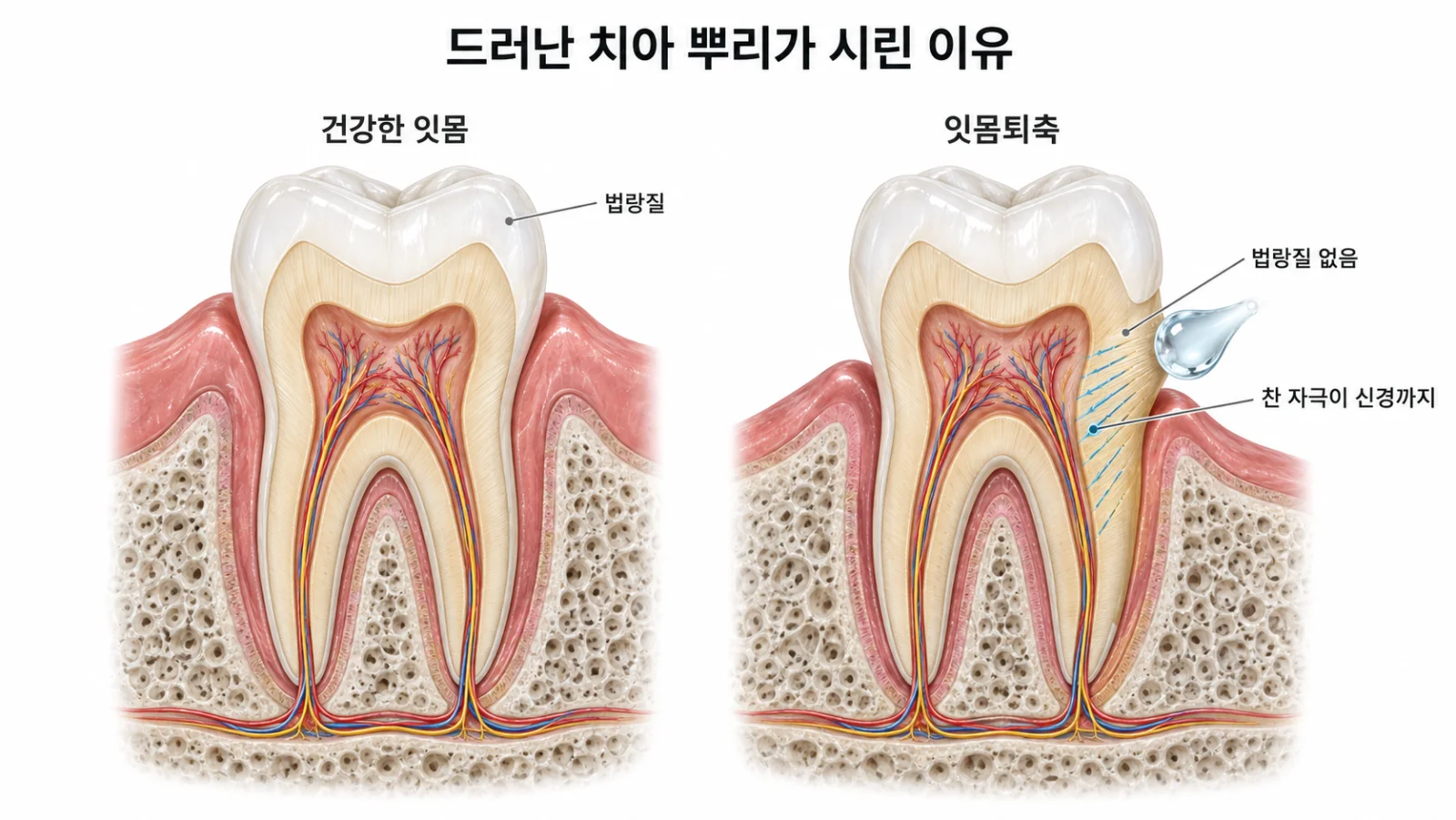 법랑질이 덮인 치아 윗부분과 법랑질이 없는 드러난 치아 뿌리를 비교해 찬 자극이 신경까지 전해지는 과정을 보여 주는 일러스트