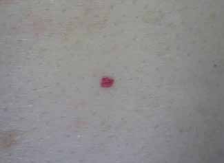 Figure 10: Capillary haemangioma