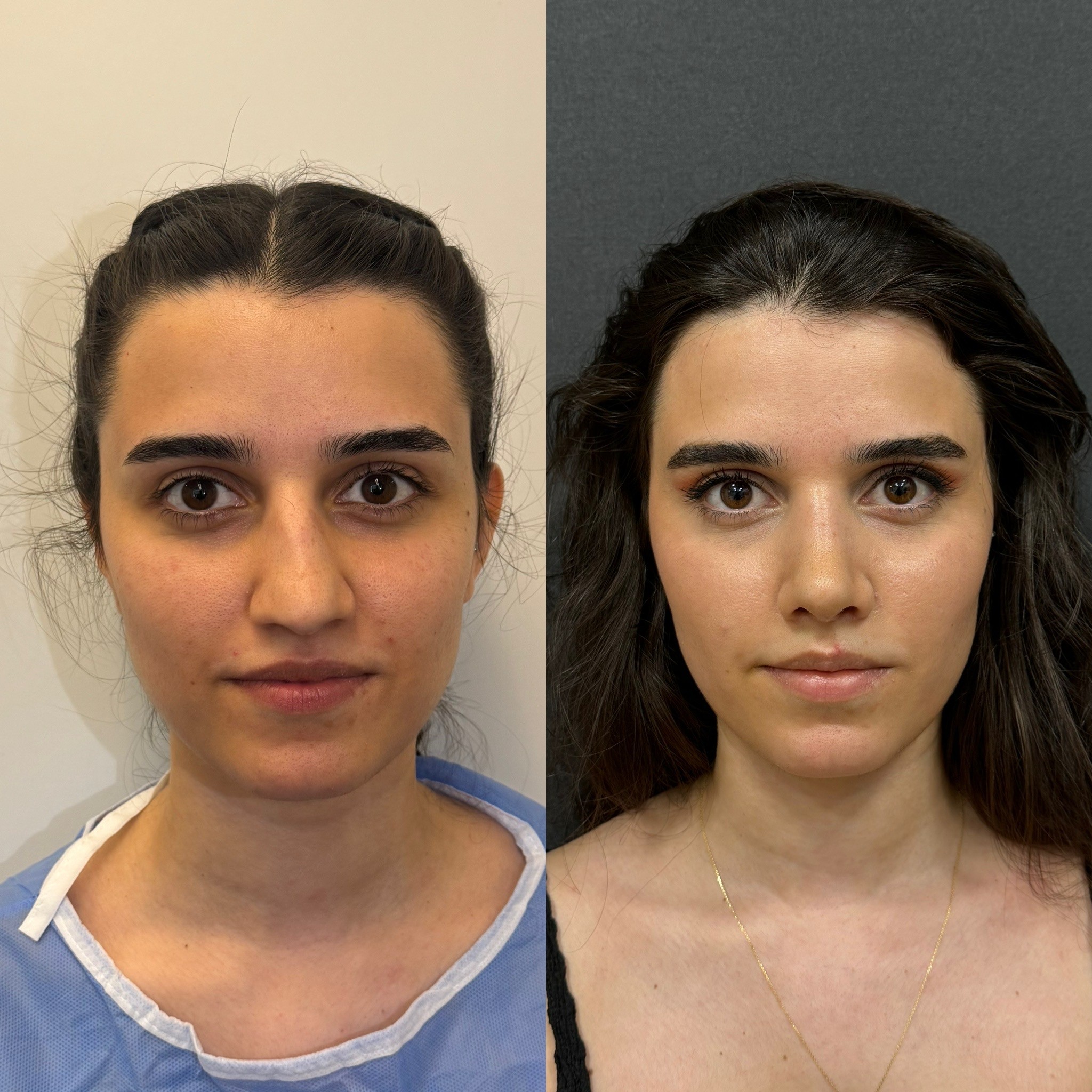 20 days post-op before after rhinoplasty patient front view serious crooked nose deformity corrected