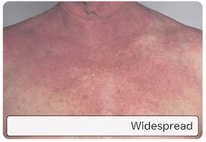 Widespread irritation