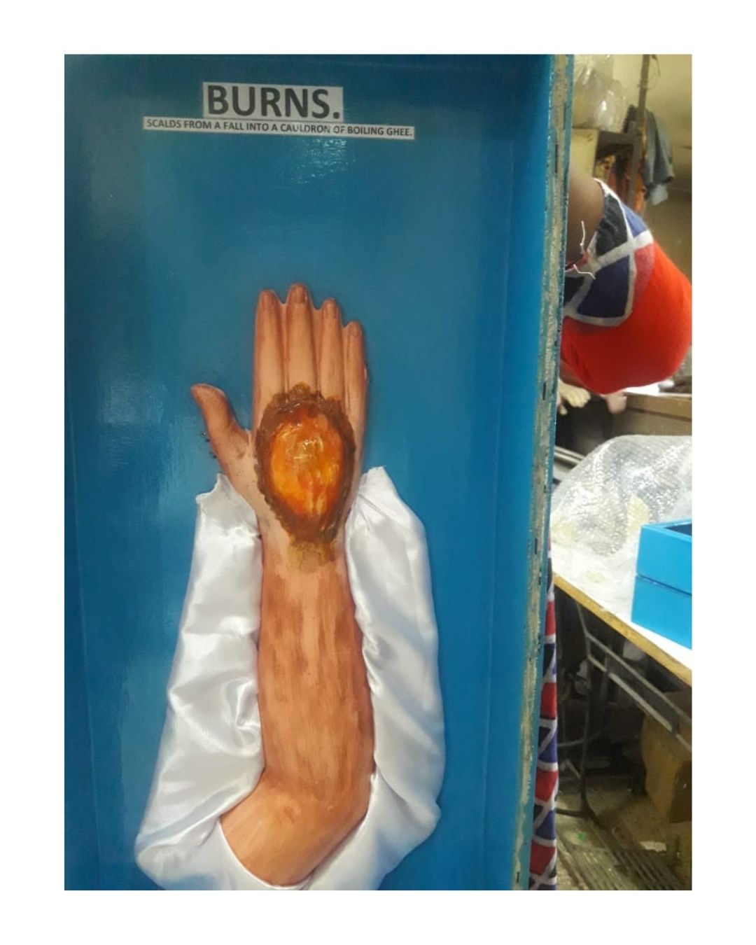 Burns (Boiling Ghee – Palm Injury)