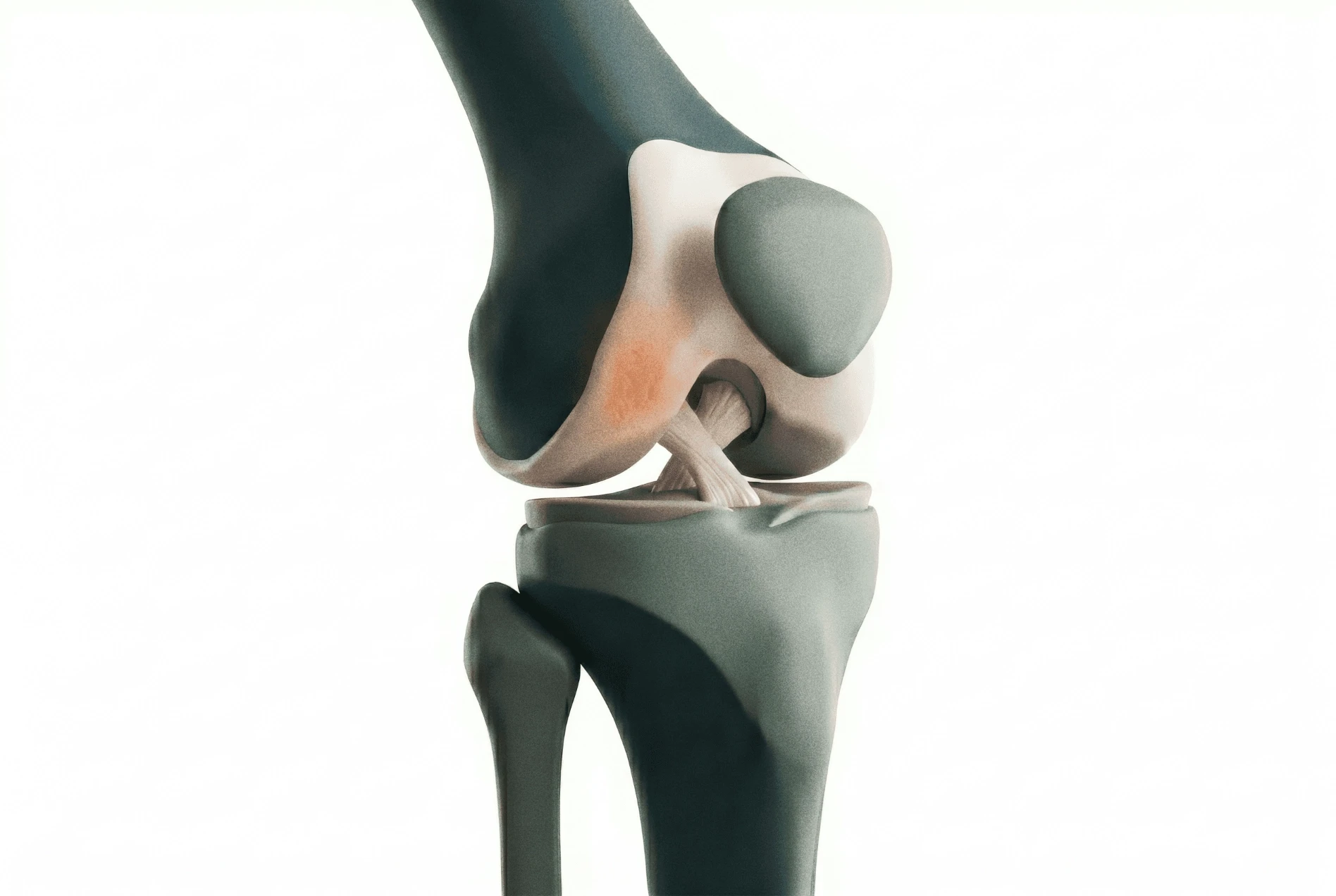 Adult Cartilage Injury Chondral