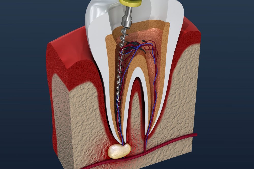Root canal colac