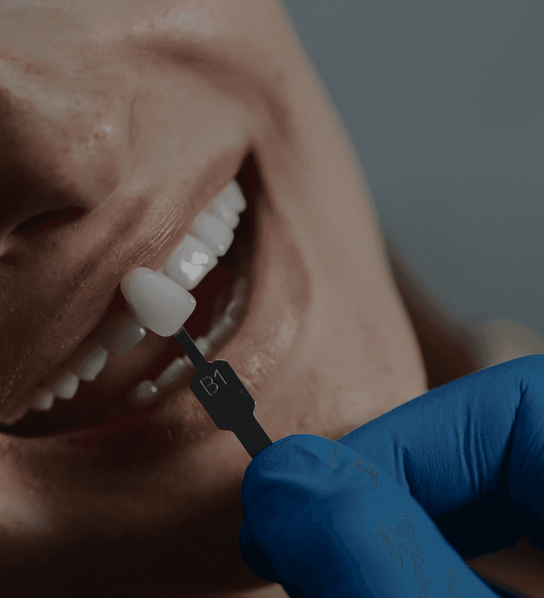 Dental Veneers & Smile Makeover
