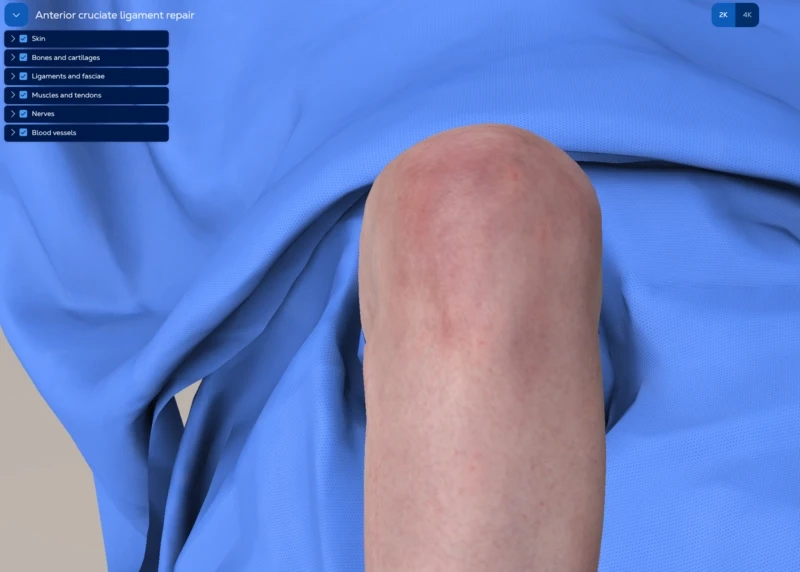 Anterior cruciate ligament (ACL) reconstruction