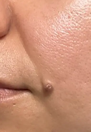 Raised mole on facial skin near upper lip.
