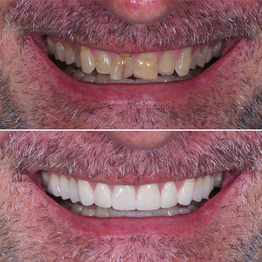 Before & After