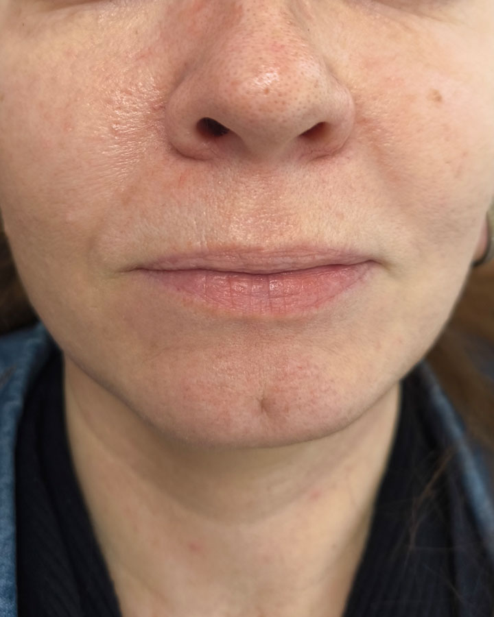 Pery so stratou hydratácie a objemu pred profesionálnym ošetrením v klinike Esthea