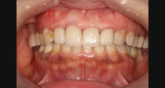 초진 133,23 착색상태