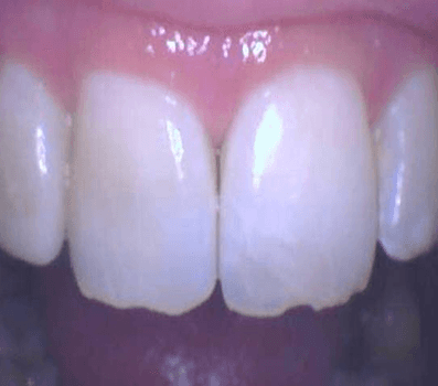 Teeth Whitening - Internal Bleaching