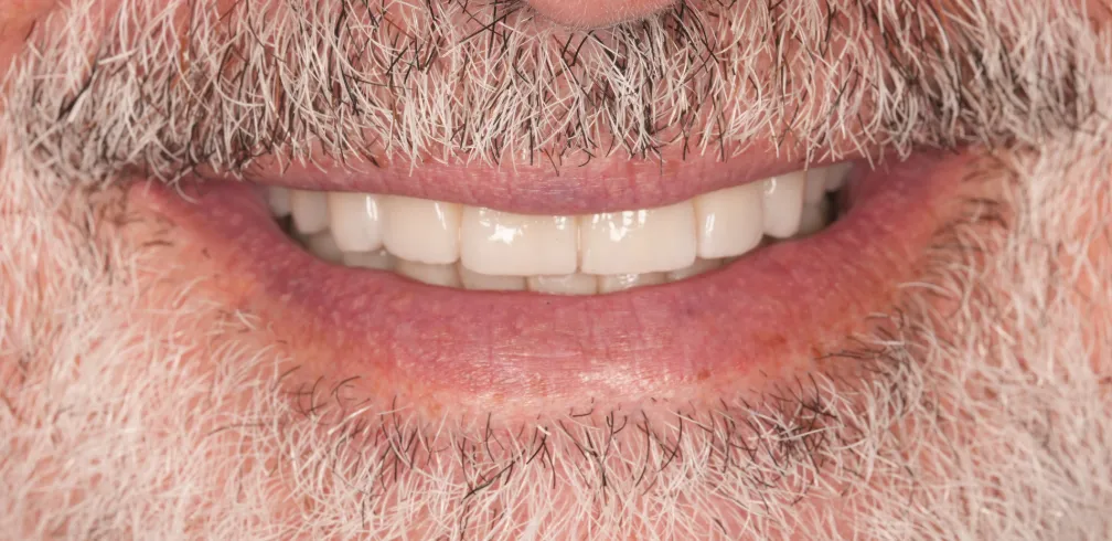 After prosthetic rehabilitation