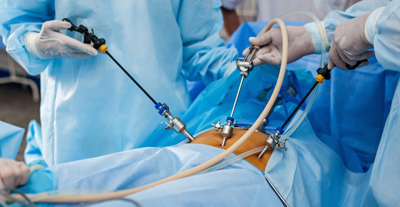 Laparoscopic Surgery