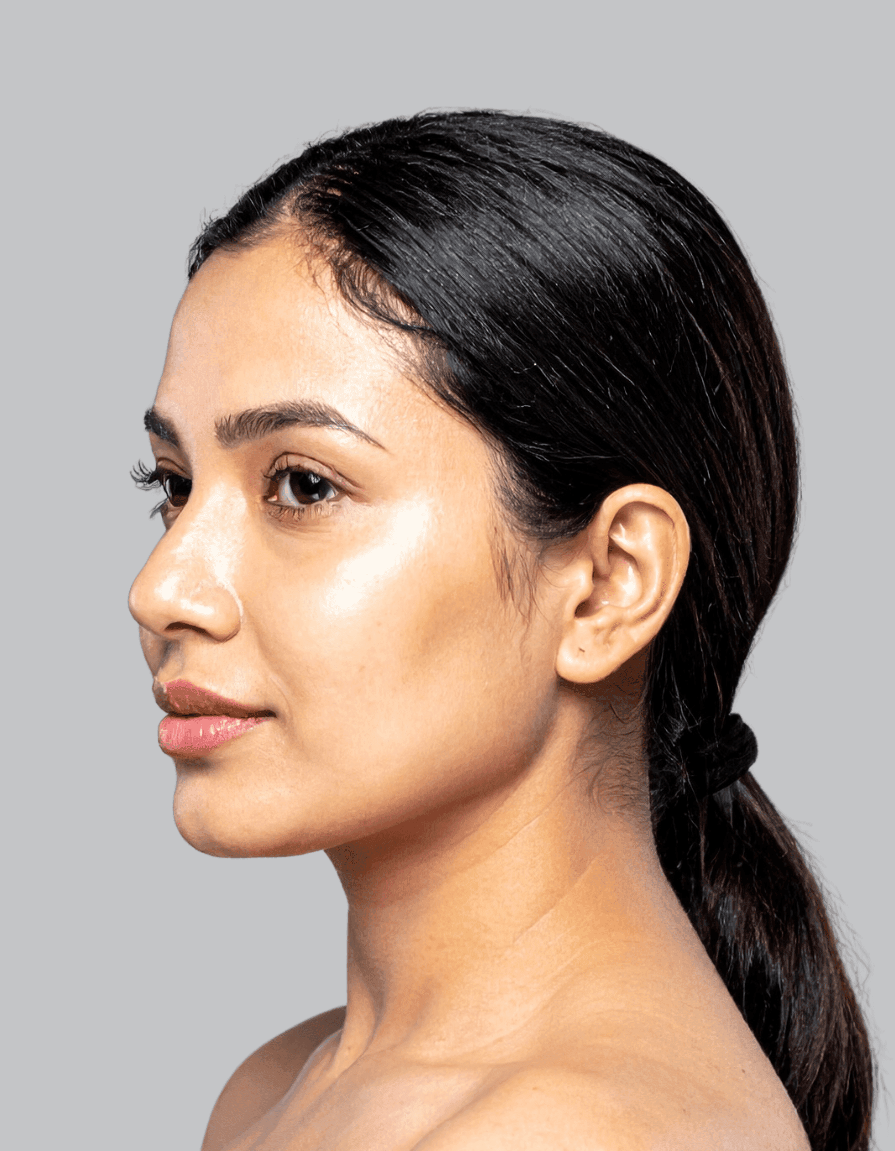 After Morpheus8 RF treatment