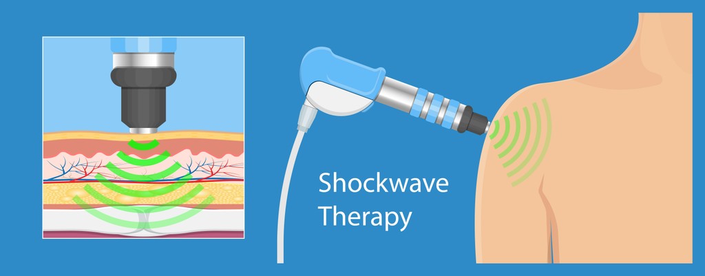 shockwave therapy graphic