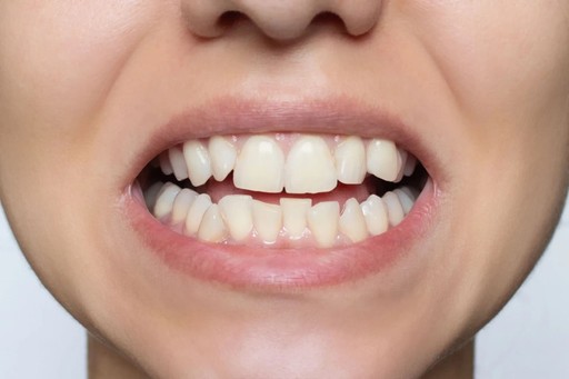 Como tratar dentes tortos: Facetas ou Aparelho?