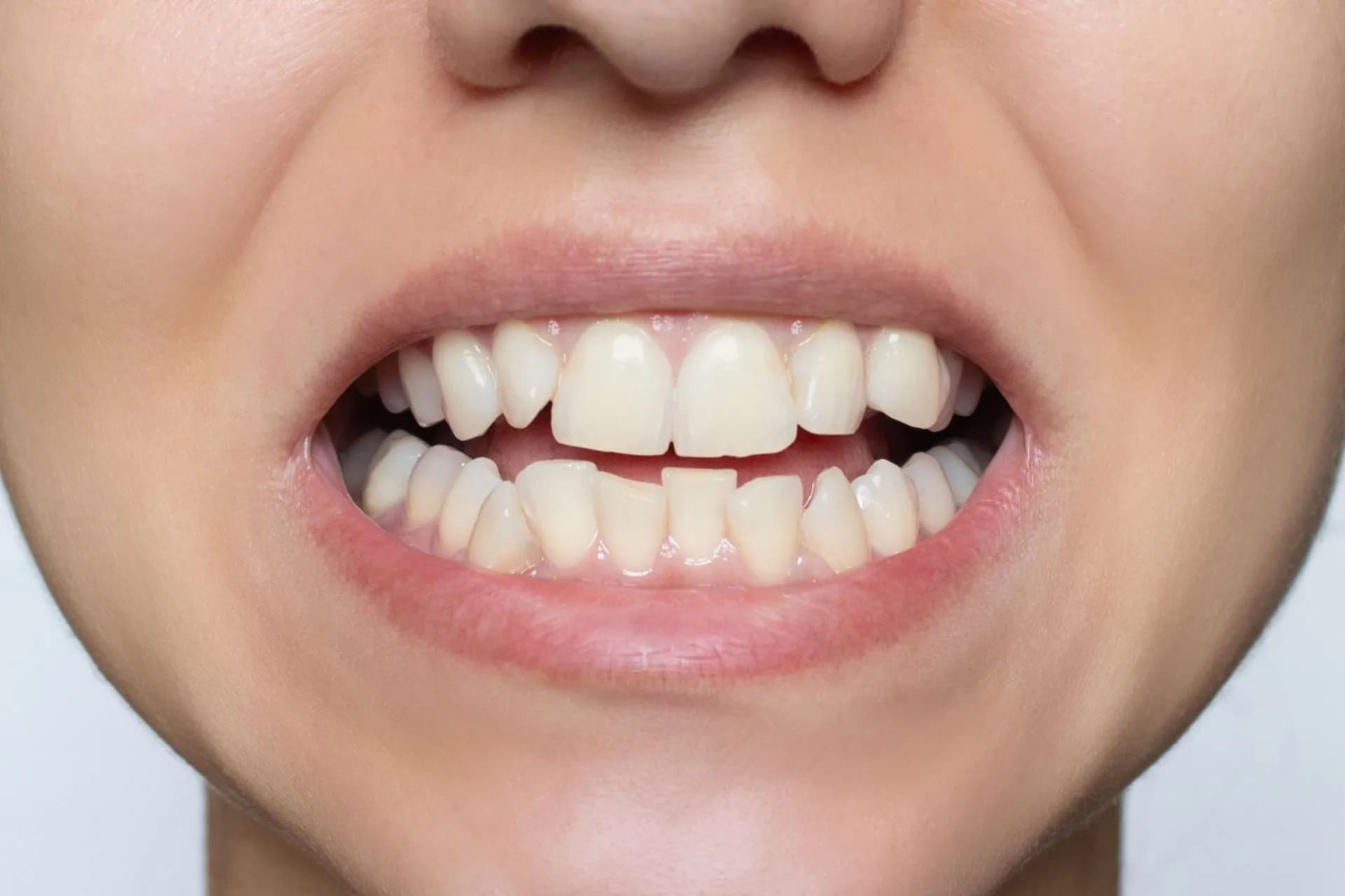 Como tratar dentes tortos: Facetas ou Aparelho?