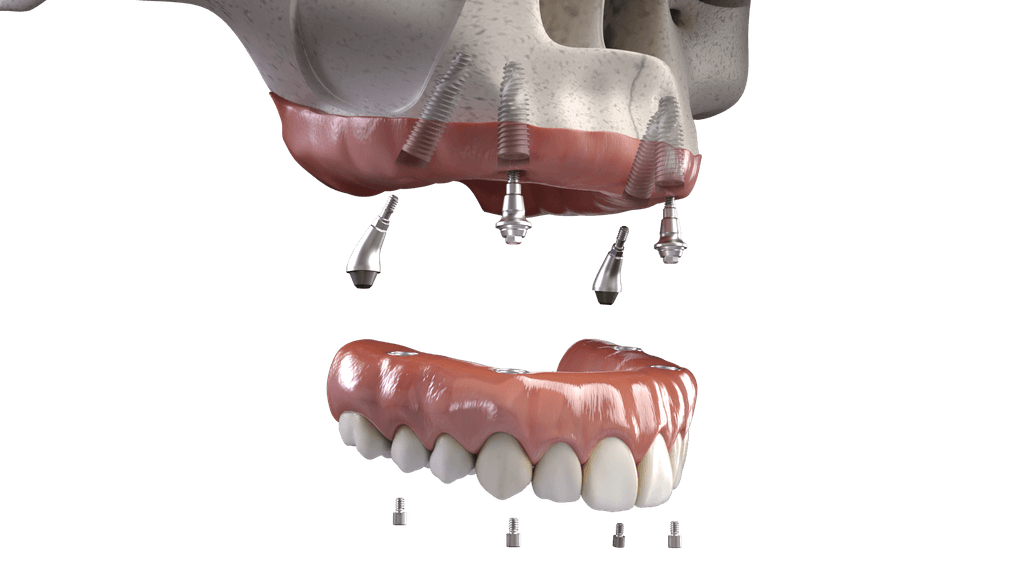 SN Family Dental All-On-X Restorations