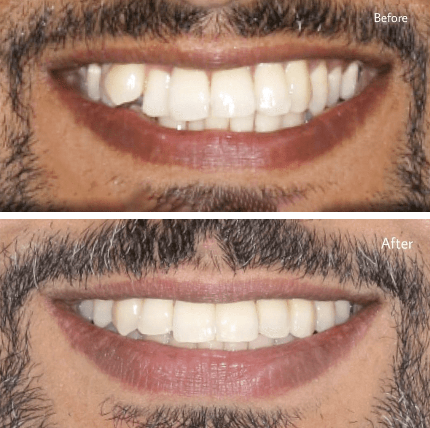 A close-up invisalign before and after photo of teeth corrected from misaligned to a straight smile at Invisalign Center in Dubai