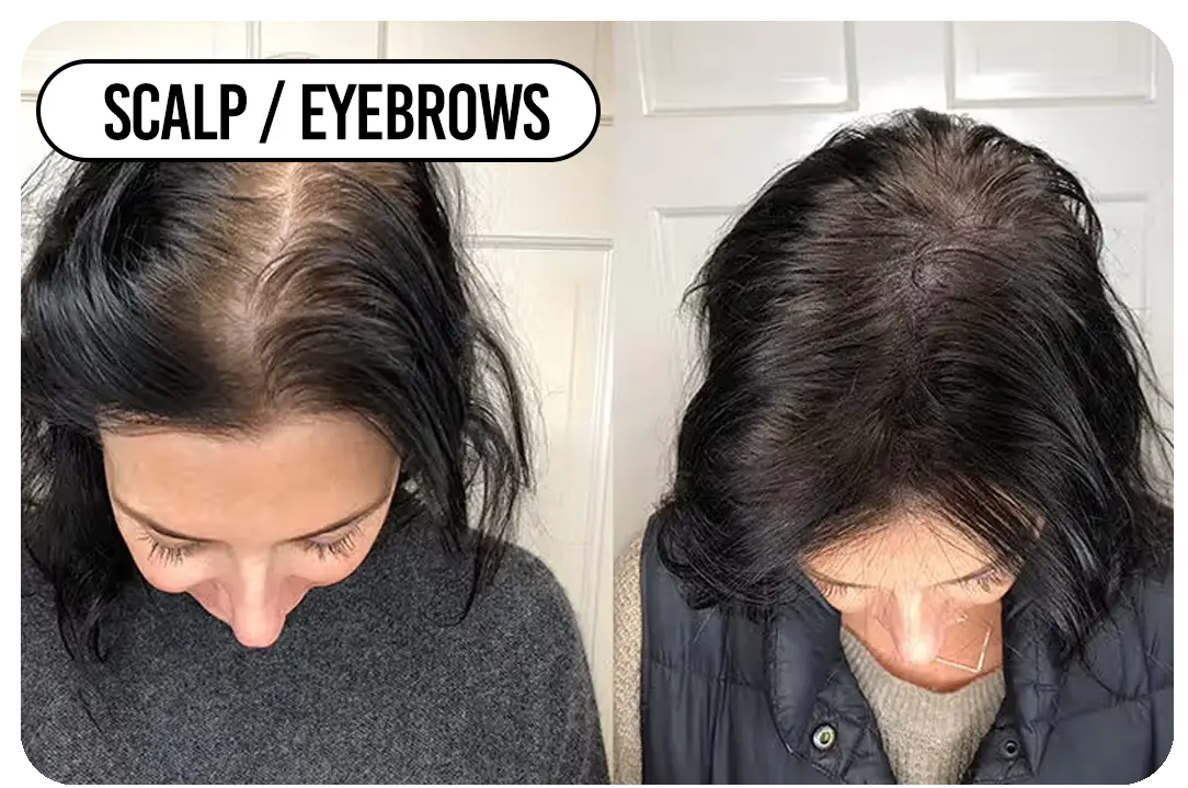 Scalp / eyebrows / creases