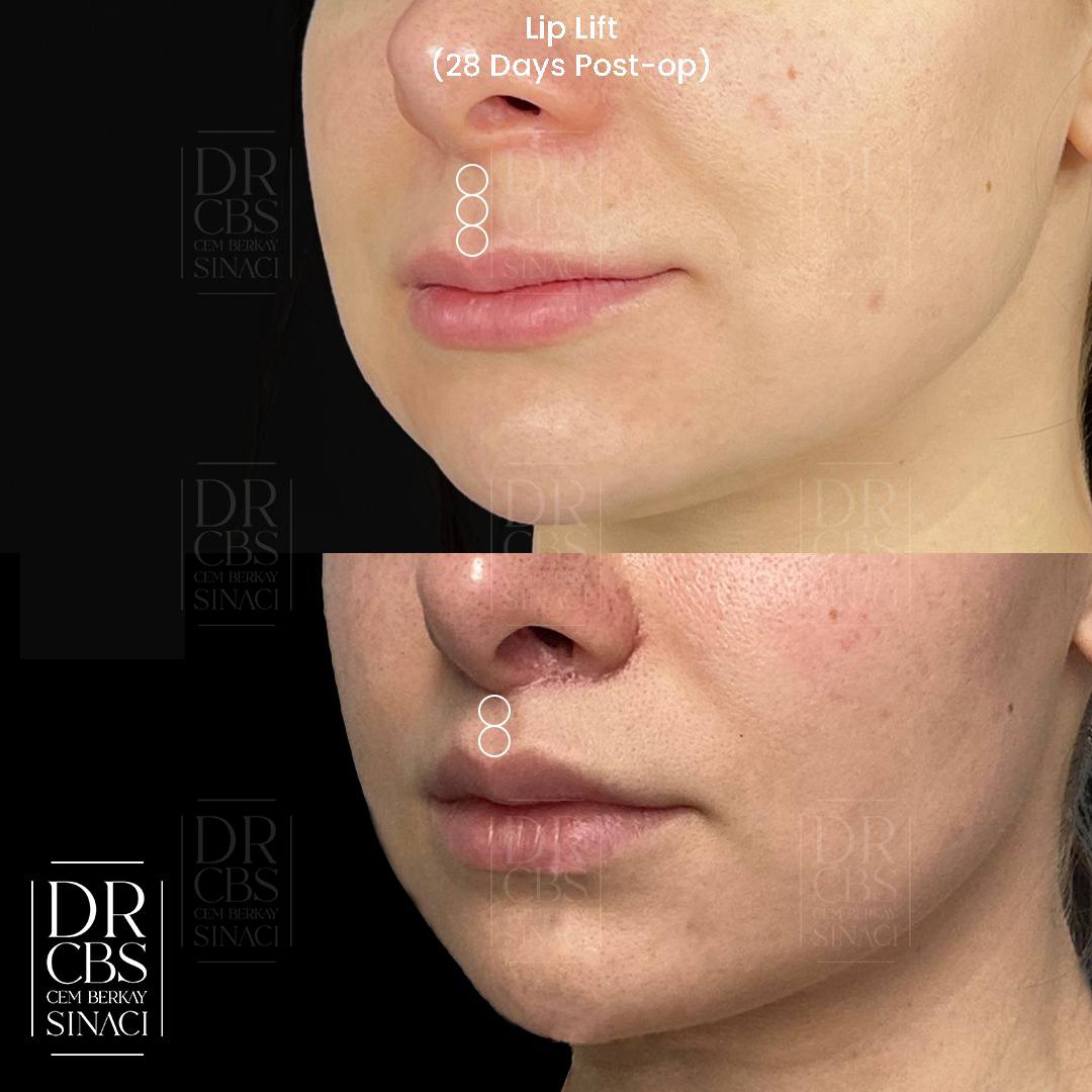 2 months result of lip lift before after oblique view