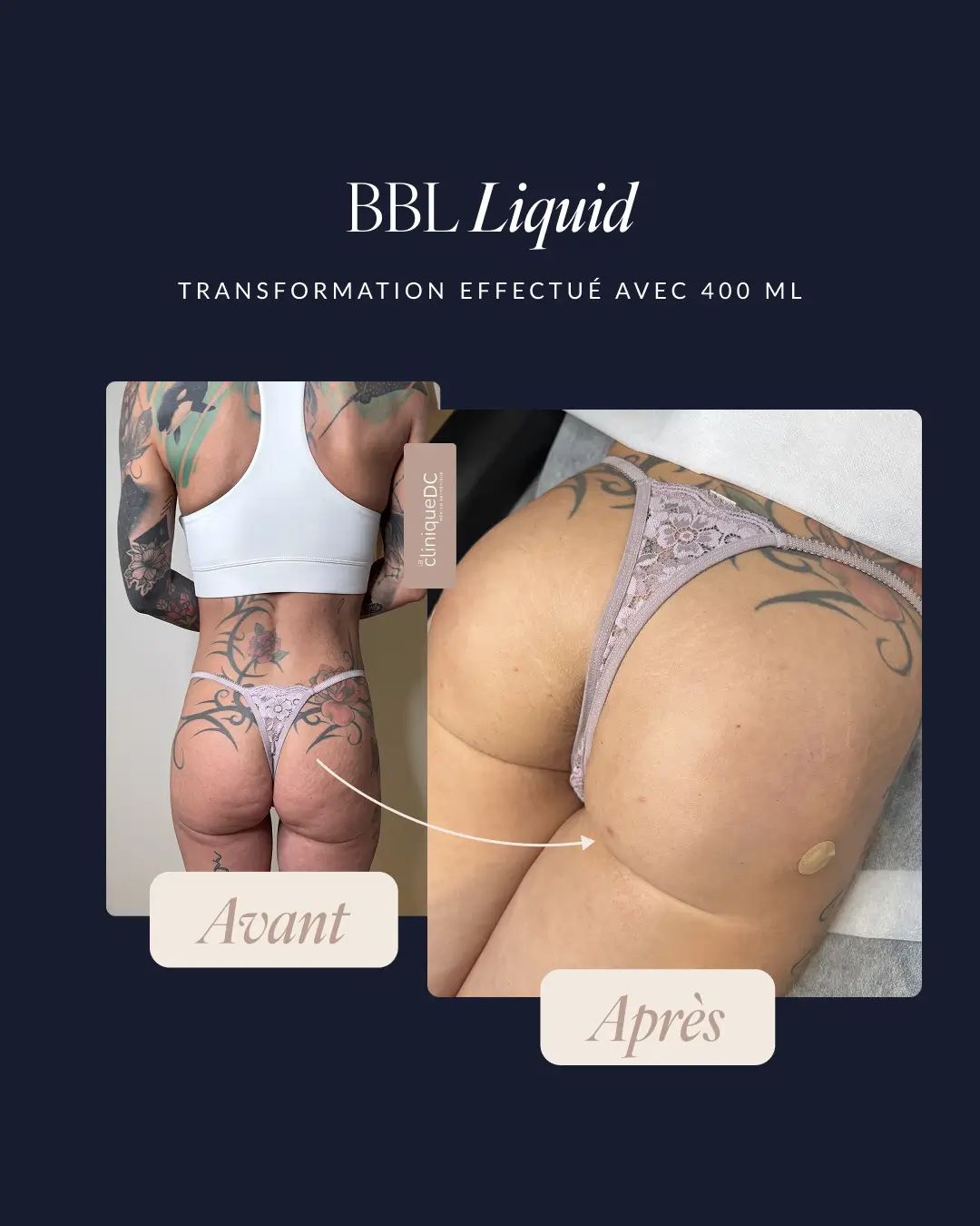 avant-après epilation laser visage