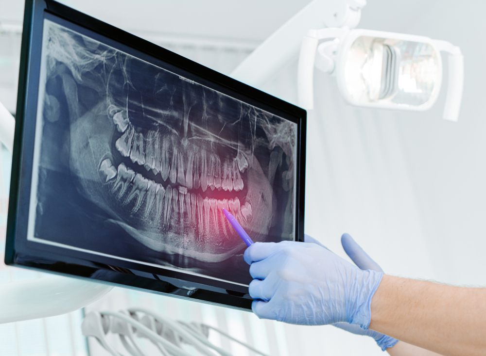 modern sensors with digital dental x-rays