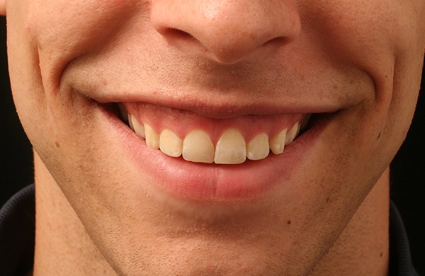 Sorriso gengival