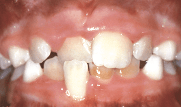 crossbite_front_teeth