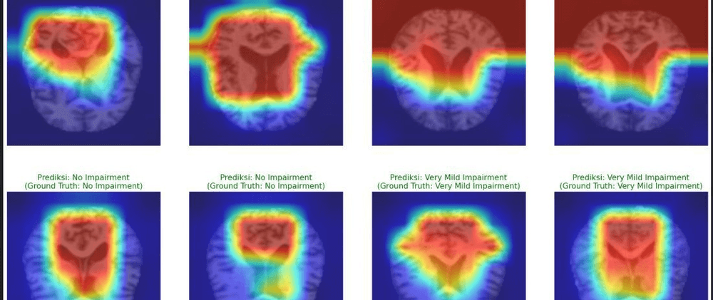 How Grad-CAM Helped Me Explain Alzheimer’s Predictions
