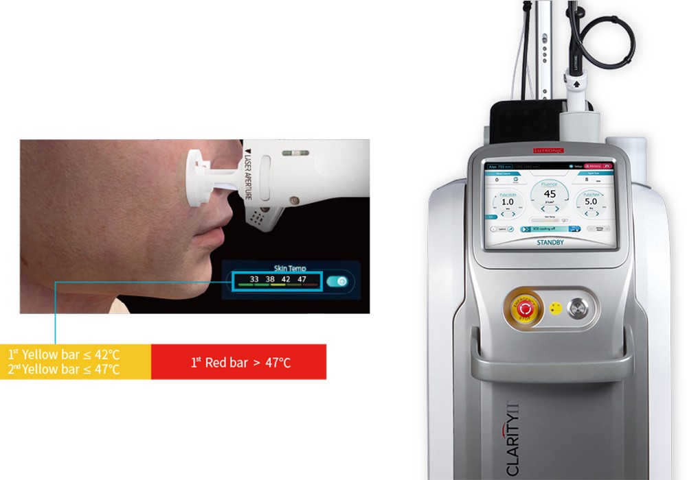 clarity ii laser for pigmentation 