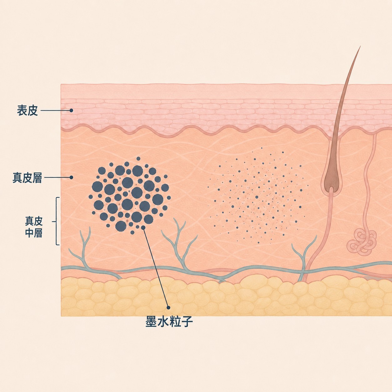 PicoWay 如何清除刺青