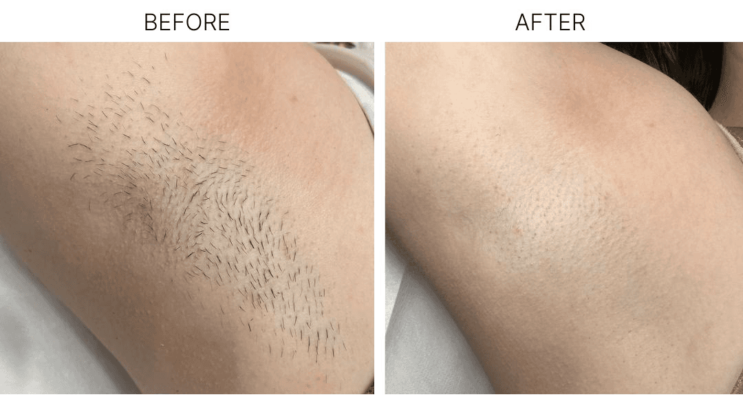 Underarm before and after