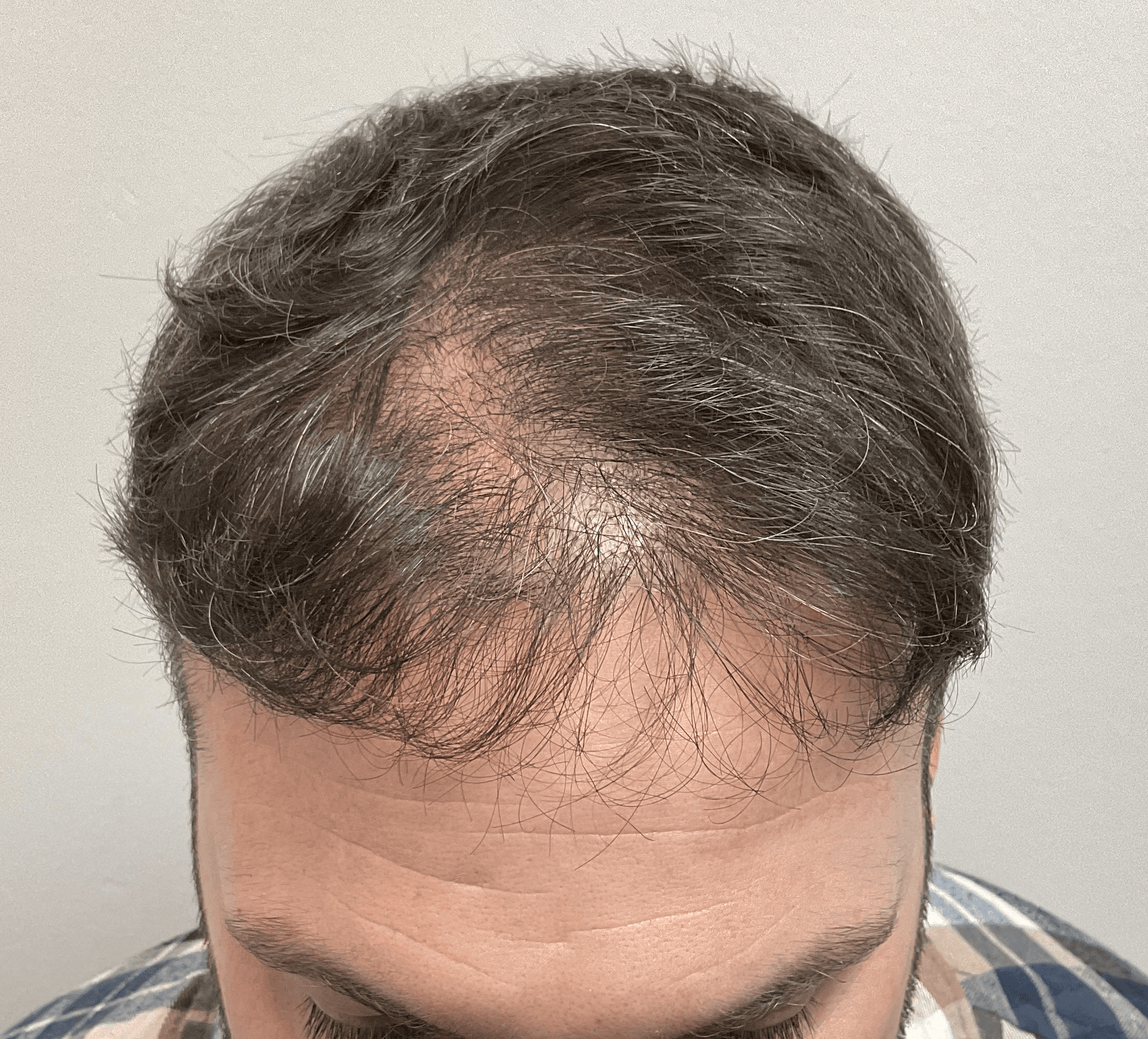 Before hair transplant – Anton's FUE Hair Transplant
