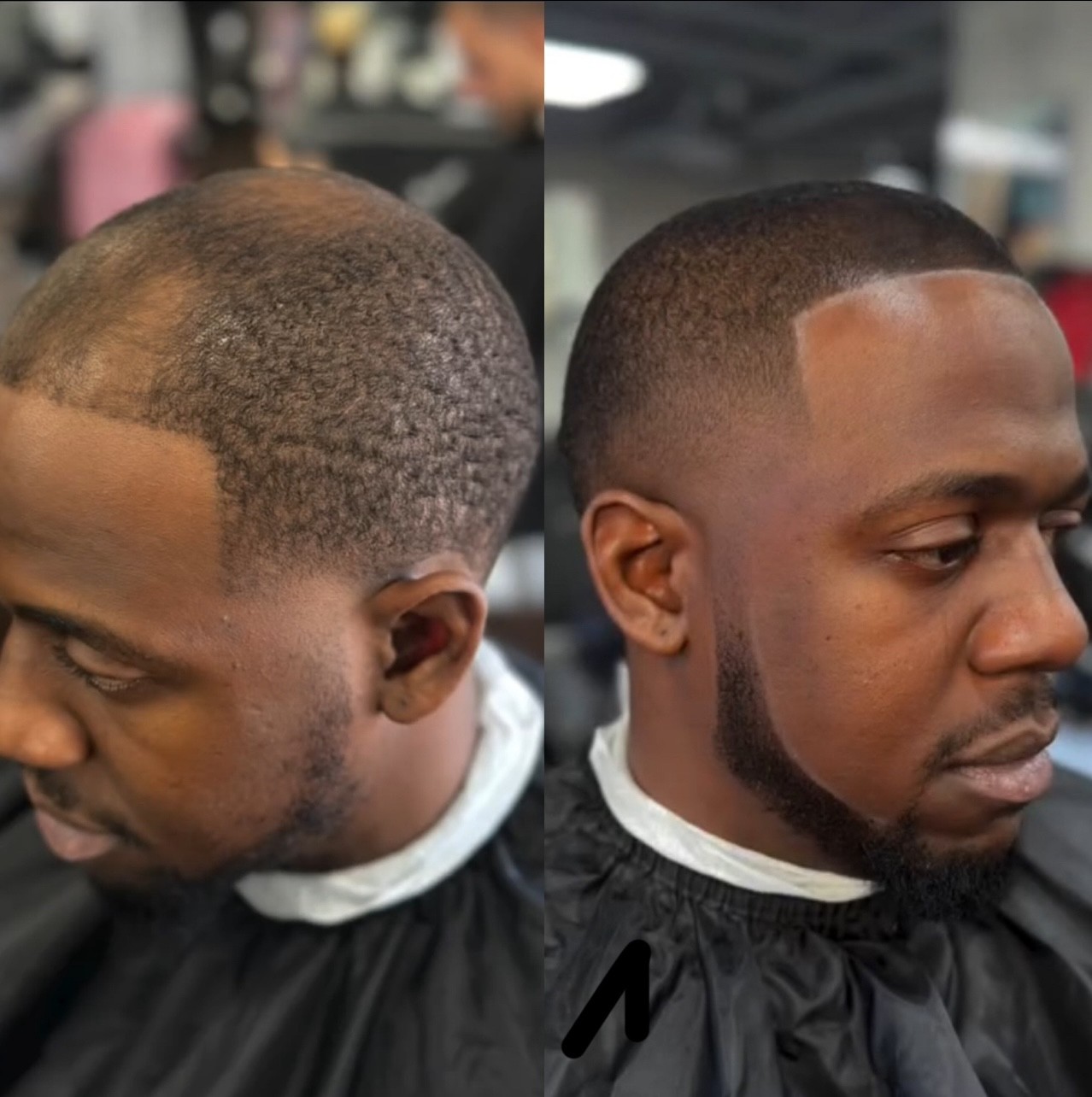 Hairline restoration and balding solution with microfiber enhancements, expertly crafted by Courtney Palmore.