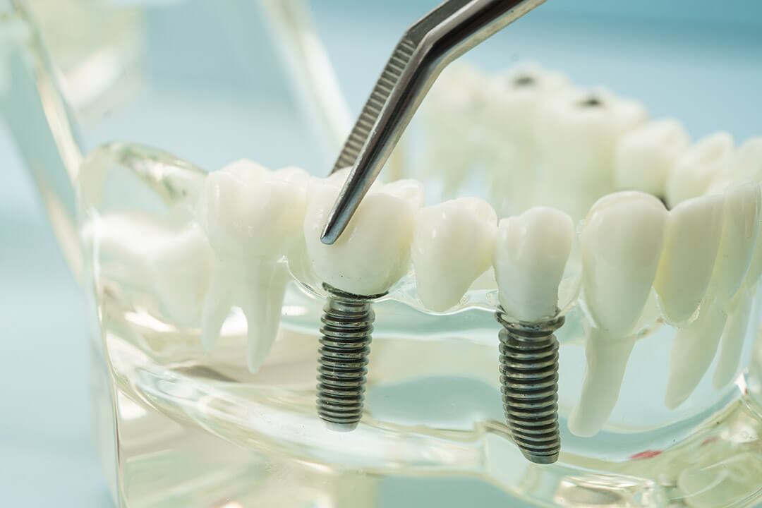 Implantes Dentários com toda a segurança