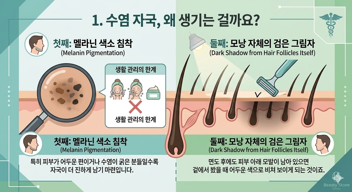 수염자국 원인 멜라닌 색소와 모낭 그림자 설명 이미지