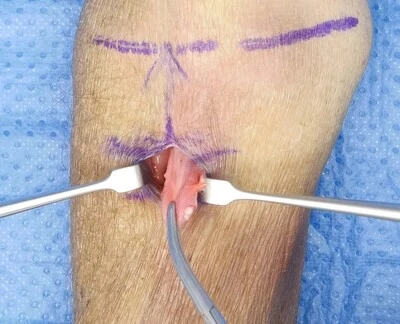 Distal biceps tendon repair