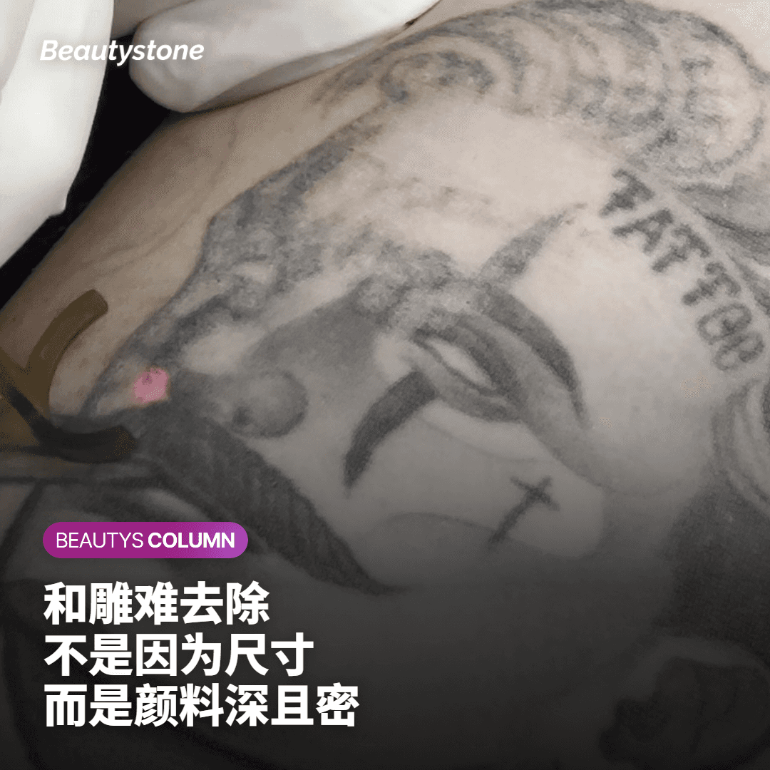 日式刺青去除激光治疗前后