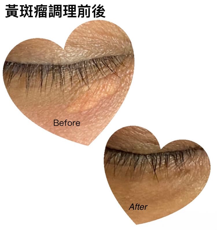 黃斑瘤調理前後