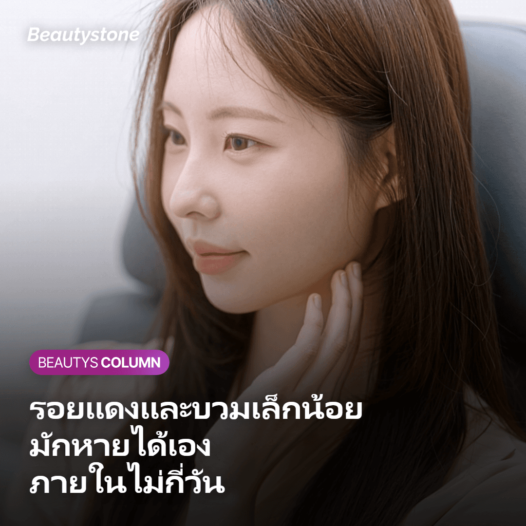 รอยแดงและบวมเล็กน้อยหลังทำ RF Lifting ที่มักหายได้เองภายในไม่กี่วัน
