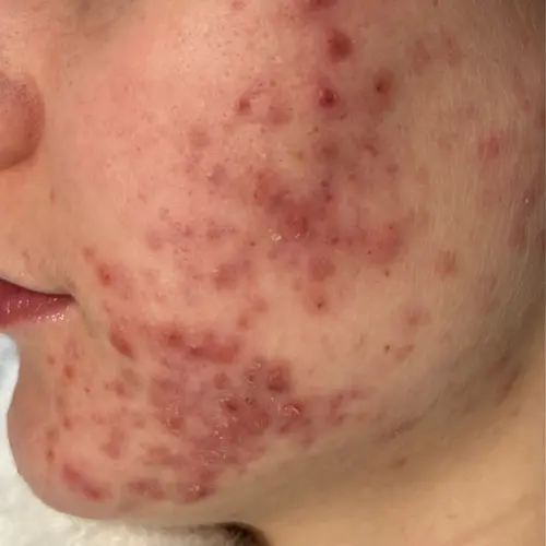 Before acne treatment at The Vancouver Aesthetician — severe hormonal and gut health related acne with significant inflammation and breakouts across skin